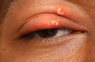 Očný herpes: Prečo vzniká a aké sú jeho základné symptómy?