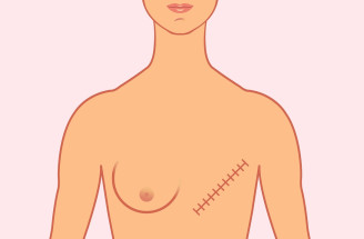 Odstránenie prsníkov alebo mastektómia – kedy ide o nevyhnutný zákrok a kedy sa robí aj preventívne?