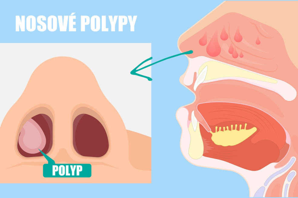 prejavy nosových polypov