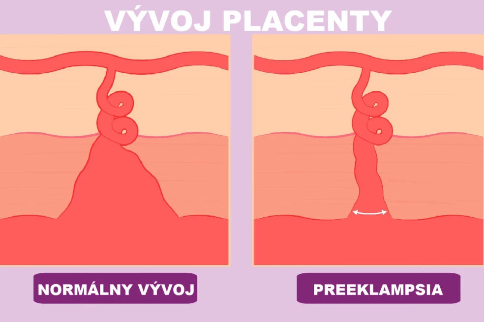 preeklampsia