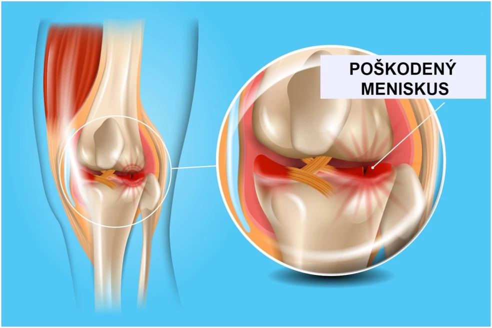 poranenie menisku