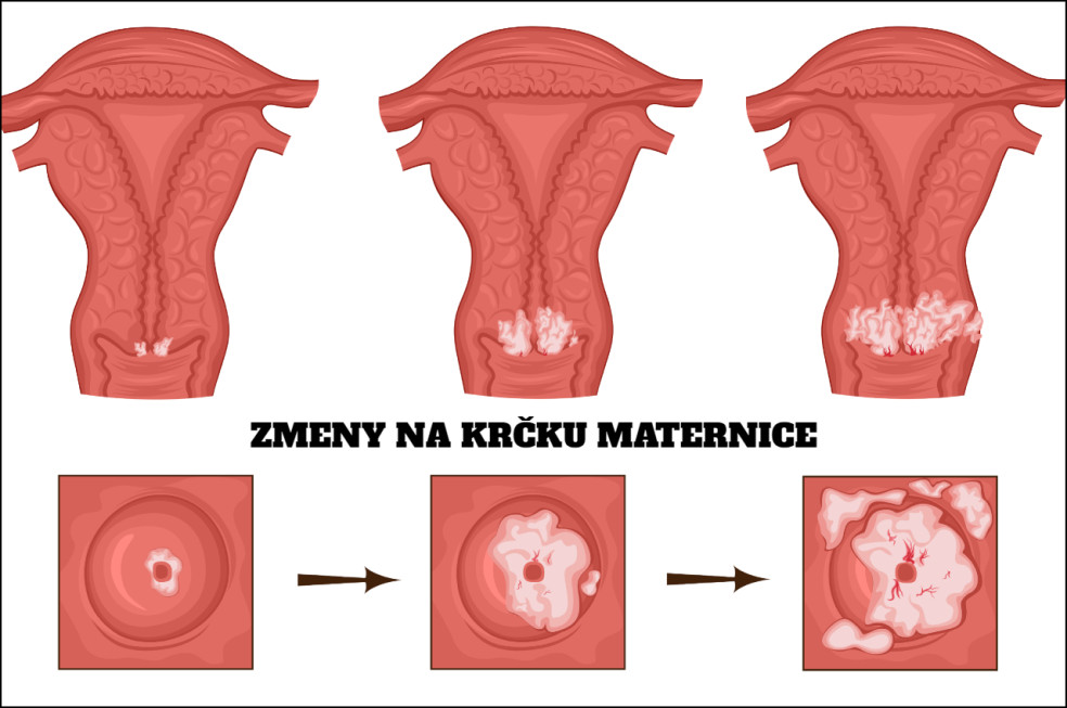 zmeny na krčku maternice