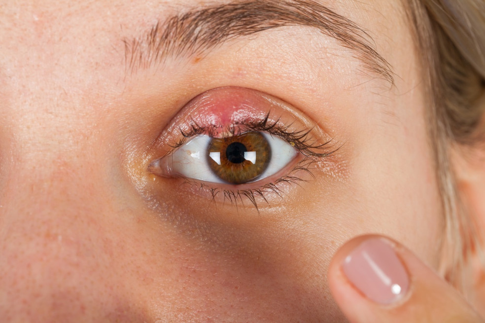príznaky zápalu oka