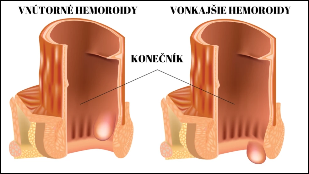 typy hemoroidov