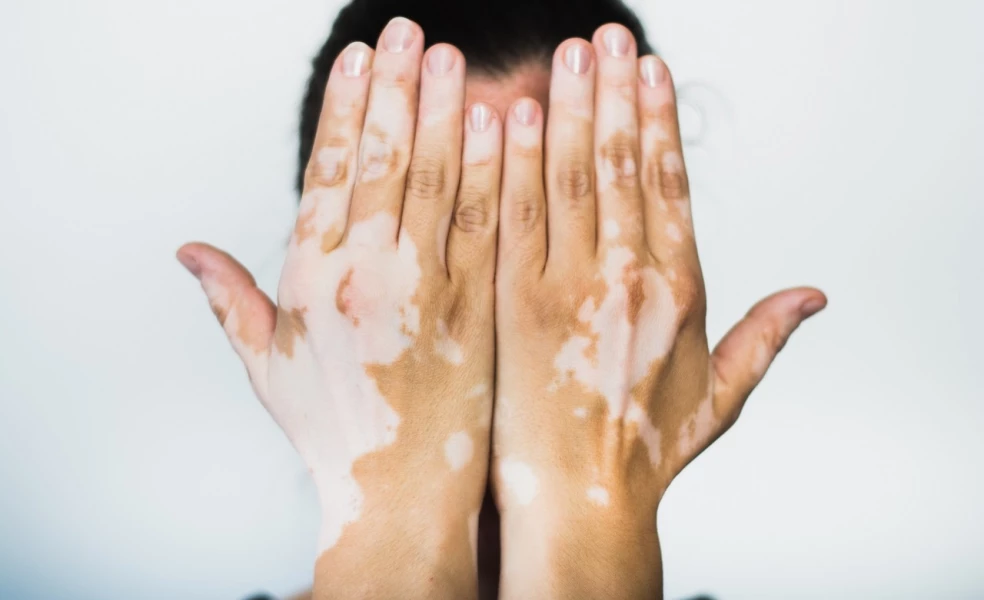 vitiligo