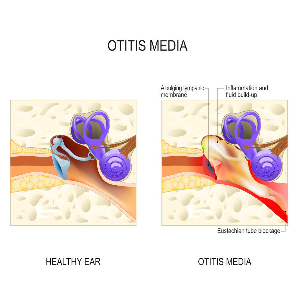 Zápal stredného ucha (otitis media). Zdravé ucho a postihnuté ucho: zapálená membrána, vznik tekutiny a narušenie Eustachovej trubice.