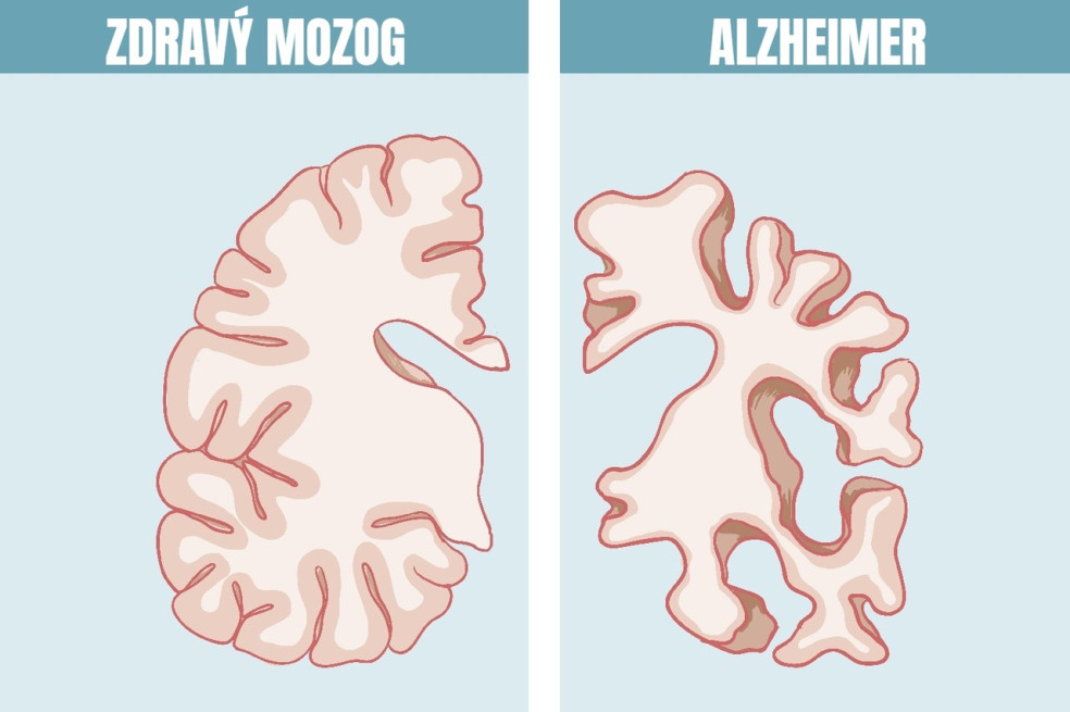 prejavy Alzheimera