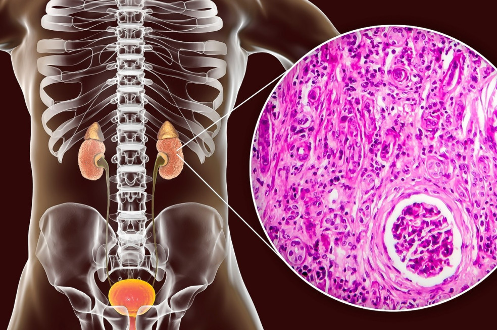 príčiny glomerulonefritídy