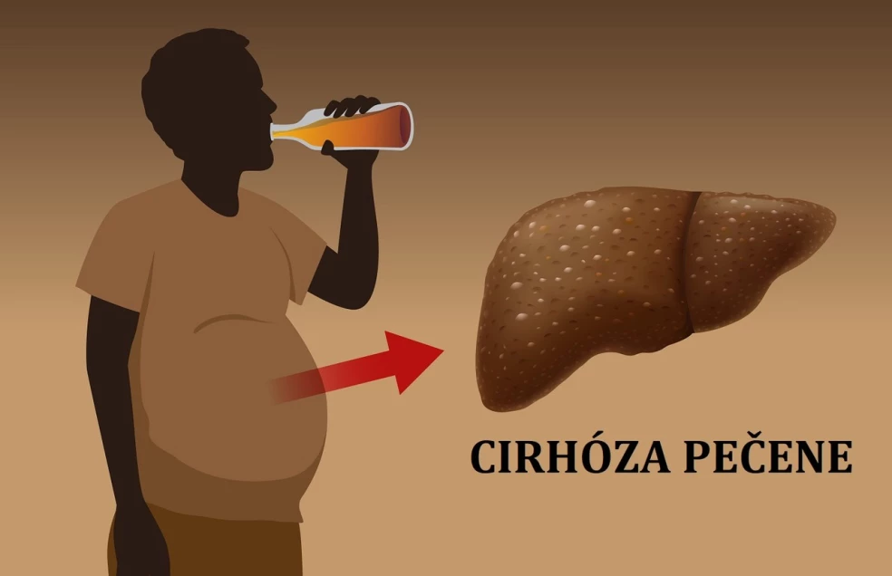 cirhóza