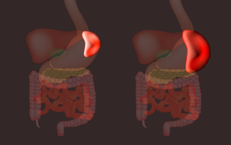 splenomegália