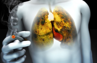 Rakovina pľúc nepostihuje len fajčiarov. Čo prispieva k vzniku choroby?