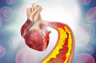 Prevencia aterosklerózy: Týchto 5 vecí môžete pre svoje zdravie spraviť i vy!