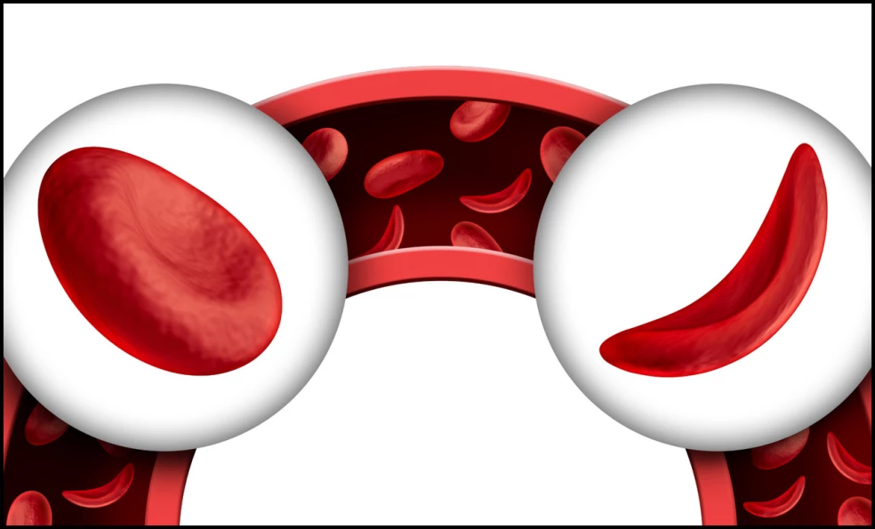 príznaky kosáčikovej anémie