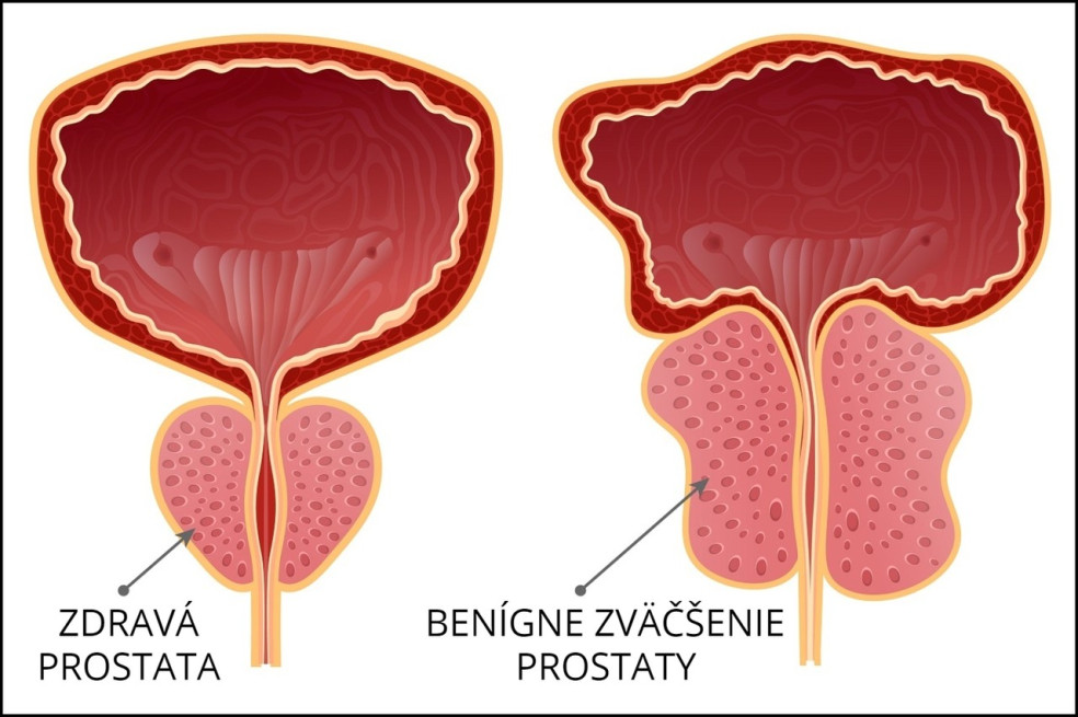 benígne zväčšenie prostaty