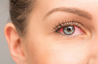 Aké sú príčiny prasknutej žilky v oku? Môže to byť vážne?