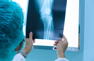 Osteosarkóm – ako sa prejavuje najčastejšia forma rakoviny kostí?