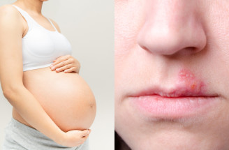 Herpes v tehotenstve – môže predstavovať zdravotné riziko pre plod?