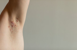 Nie vždy ide o ekzém či akné: Ako spoznať zriedkavé kožné ochorenia?