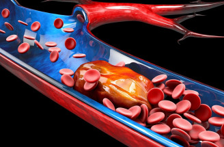 Hlboká žilová trombóza: Ktoré prejavy zrazeniny v žilách neignorovať?