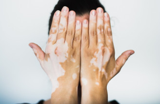 Vitiligo a jeho prejavy – sú biele fľaky na koži nákazlivé či bolestivé?