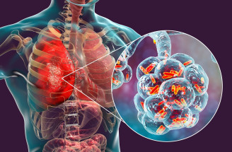 Vážna a život ohrozujúca choroba – ako sa prejavuje zápal pľúc?