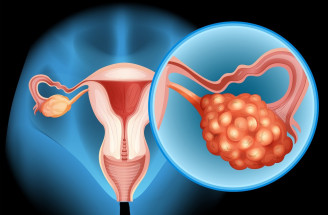 Hlavné rizikové faktory rakoviny vaječníkov: Je zásadná dedičnosť?