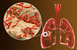 Tuberkulóza – aké sú príčiny, prejavy, liečba a prevencia choroby?