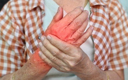 tendinitída zápal šliach