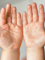 Rubeola je dnes zriedkavá, no nevymizla. Môže mať vážne následky?