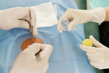 Biopsia – kedy sa uplatňuje, ako prebieha a aké sú možné riziká?
