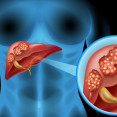 Rakovina pečene – aké sú príznaky, rizikové faktory pre vznik a možnosti liečby?