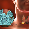Aké sú príčiny rakoviny štítnej žľazy? Toto sú rizikové faktory!