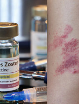 Očkovanie proti pásovému oparu – ktoré rizikové osoby by ho mali zvážiť?