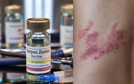 Očkovanie proti pásovému oparu