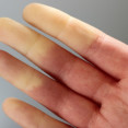 Máte biele prsty od zimy? Možno máte Raynaudovu chorobu
