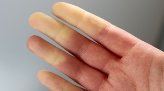 Máte biele prsty od zimy? Možno máte Raynaudovu chorobu