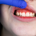 Ako sa prejavuje gingivitída? Hlavné príznaky zápalu neignorujte!
