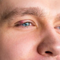 Jačmeň na oku: Aké sú príčiny a čo pomôže uľaviť od ťažkostí?