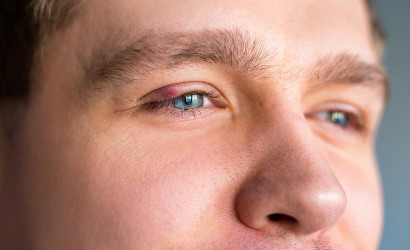 Jačmeň na oku: Aké sú príčiny a čo pomôže uľaviť od ťažkostí?