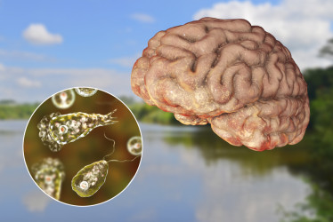 Améba Naegleria fowleri (slzovnička zhubná) – čo treba vedieť o tejto vážnej infekcii mozgu?