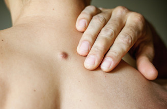Dermatofibróm: Neškodný hrbolček na koži alebo dôvod na obavy?