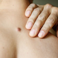 Dermatofibróm: Neškodný hrbolček na koži alebo dôvod na obavy?