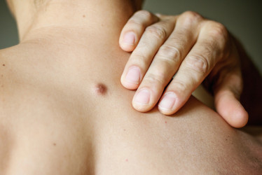 Dermatofibróm: Neškodný hrbolček na koži alebo dôvod na obavy?