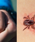 Lymská borelióza pod lupou: Čo by ste mali vedieť o tejto kliešťami prenášanej infekcii?