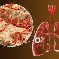 Tuberkulóza – aké sú príčiny, prejavy, liečba a prevencia choroby?