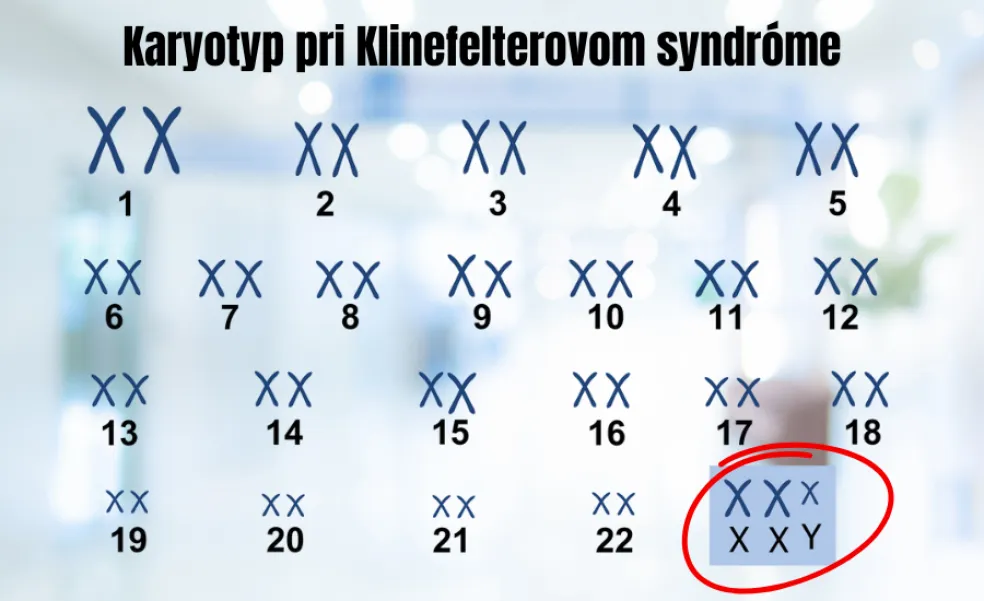 Karyotyp pri Klinefelterovom syndróme