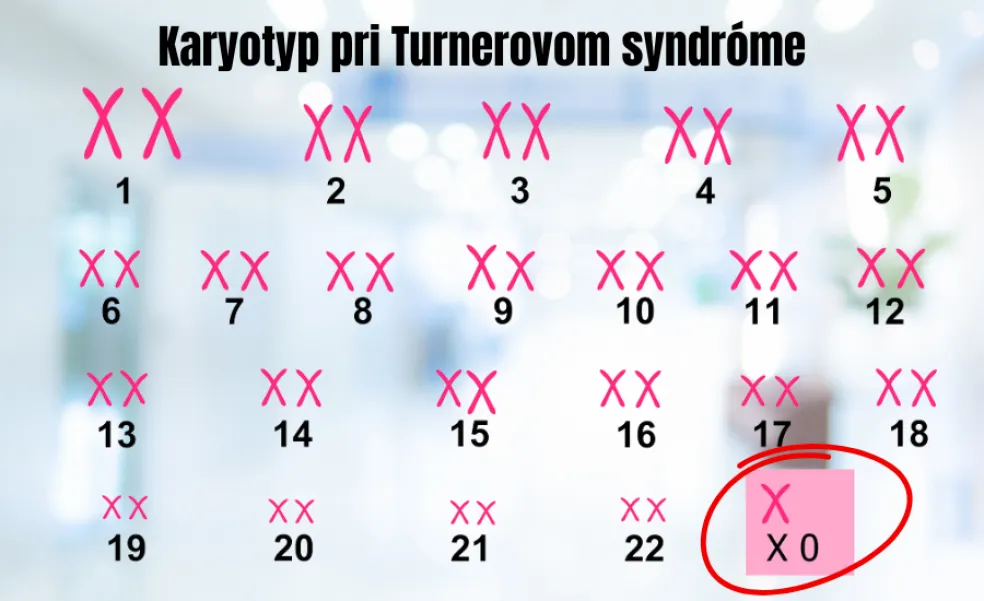 Typy Turnerovho syndrómu
