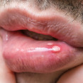 Afty v ústach – ktorí prírodní pomocníci s nimi rýchlo skoncujú?