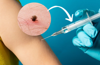 Očkovanie proti kliešťovej encefalitíde – kedy o ňom uvažovať a aké sú riziká?