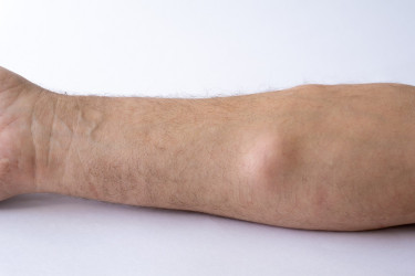 Mäkká alebo tvrdá hrčka pod kožou – čo môžu znamenať rôzne podkožné útvary?